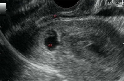 Aklama: Aklama: Cesarean Scar Pregnancy Treated Picture 1